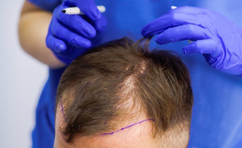 Пересадка волос — что это и сколько стоит?